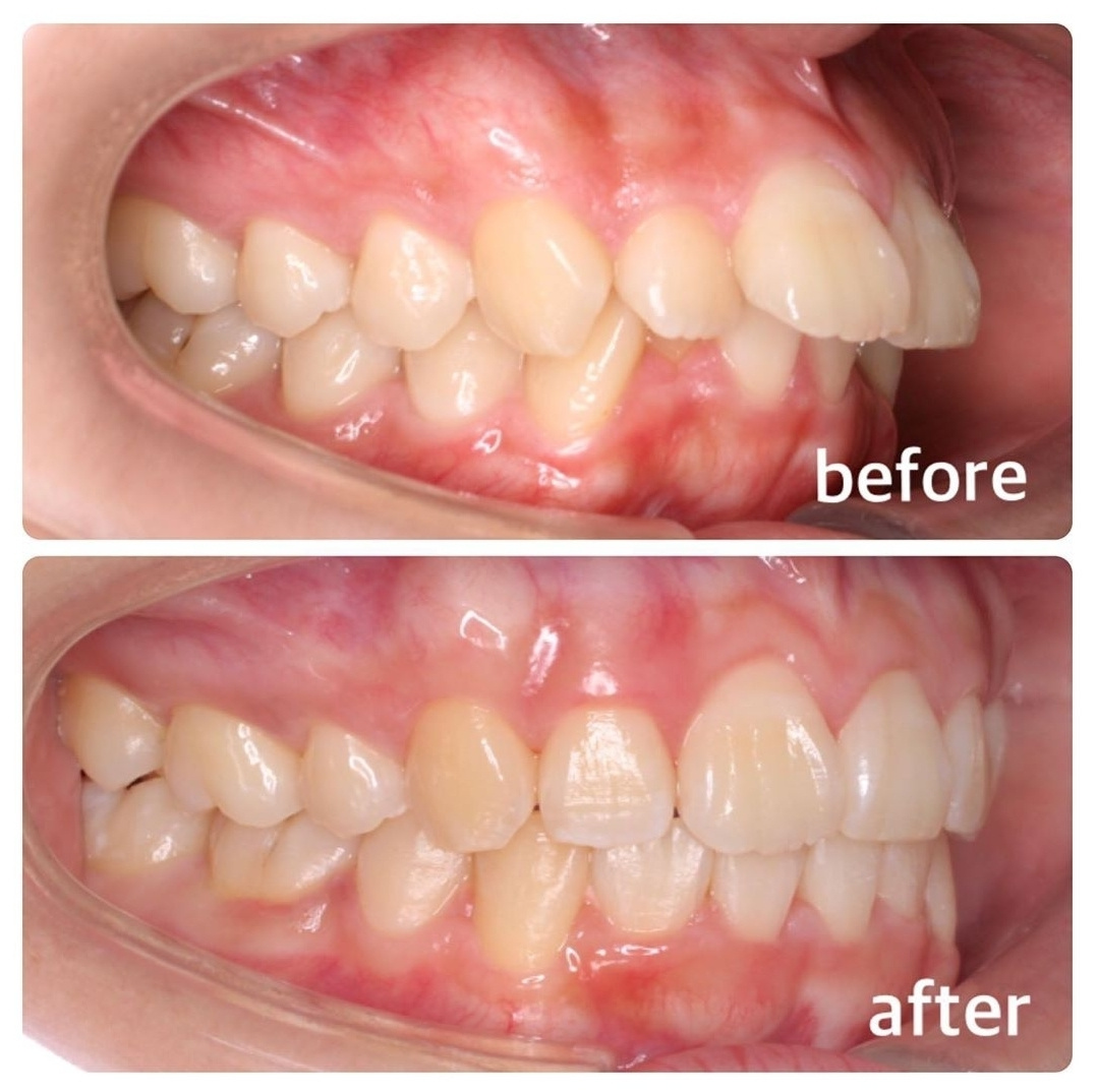 出っ歯の矯正症例⓶広島で「安い・人気・おすすめ」の抜かない歯列矯正専門歯科