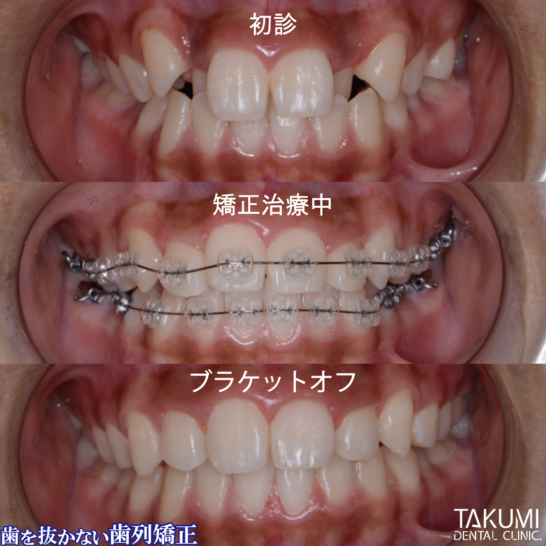 広島で「安い・人気・おすすめ」の抜かない矯正専門歯科医院
