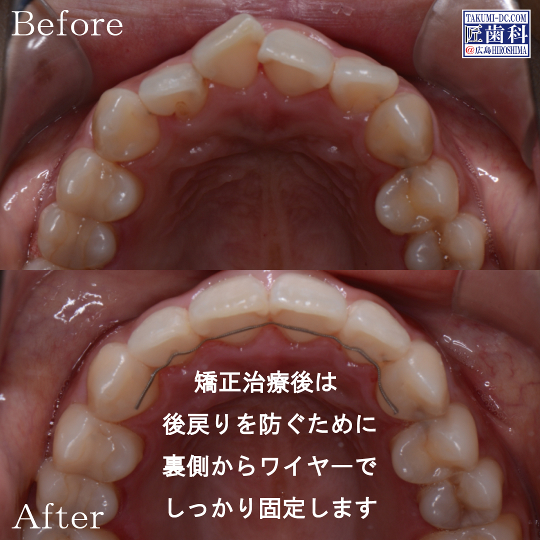 部分矯正 広島 おすすめ 人気 安い 矯正歯科