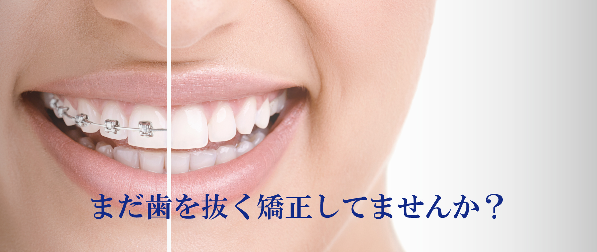 広島で「安い・人気・おすすめ」の抜かない矯正専門歯科医院 子供の矯正 子どもの矯正 小児矯正