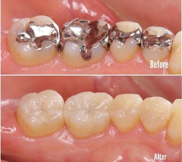 銀歯と白い歯の比較