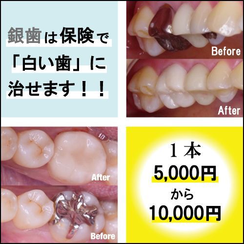銀歯➔白い歯＠広島で「安い・人気・おすすめ」の抜かない歯列矯正認定専門歯科