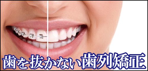 歯を抜かない歯列矯正＠広島で「安い・人気・おすすめ」の抜かない歯列矯正認定専門歯科