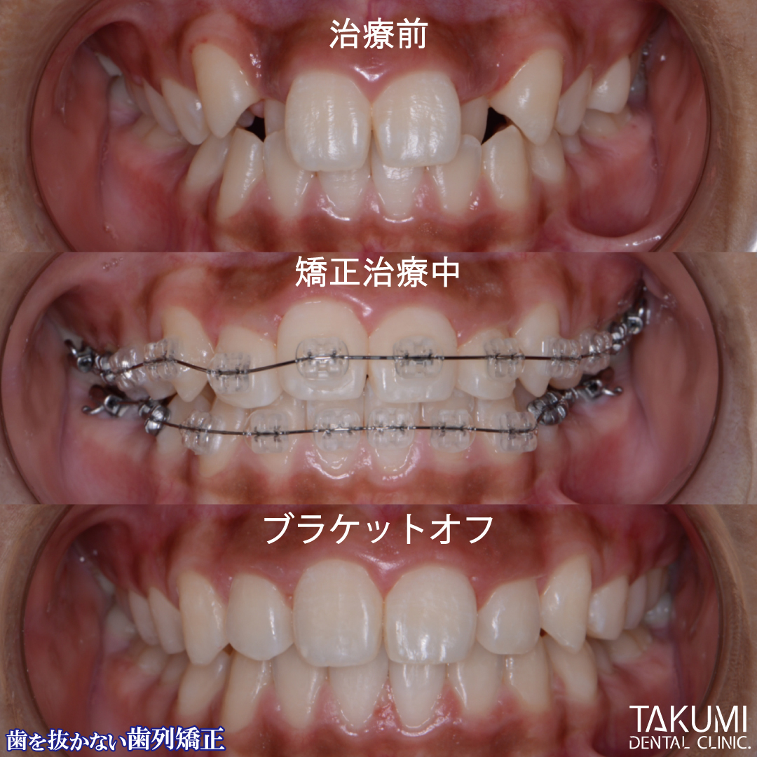 矯正治療経過 矯正歯科装置 広島で「安い・人気・おすすめ」の抜かない矯正専門歯科