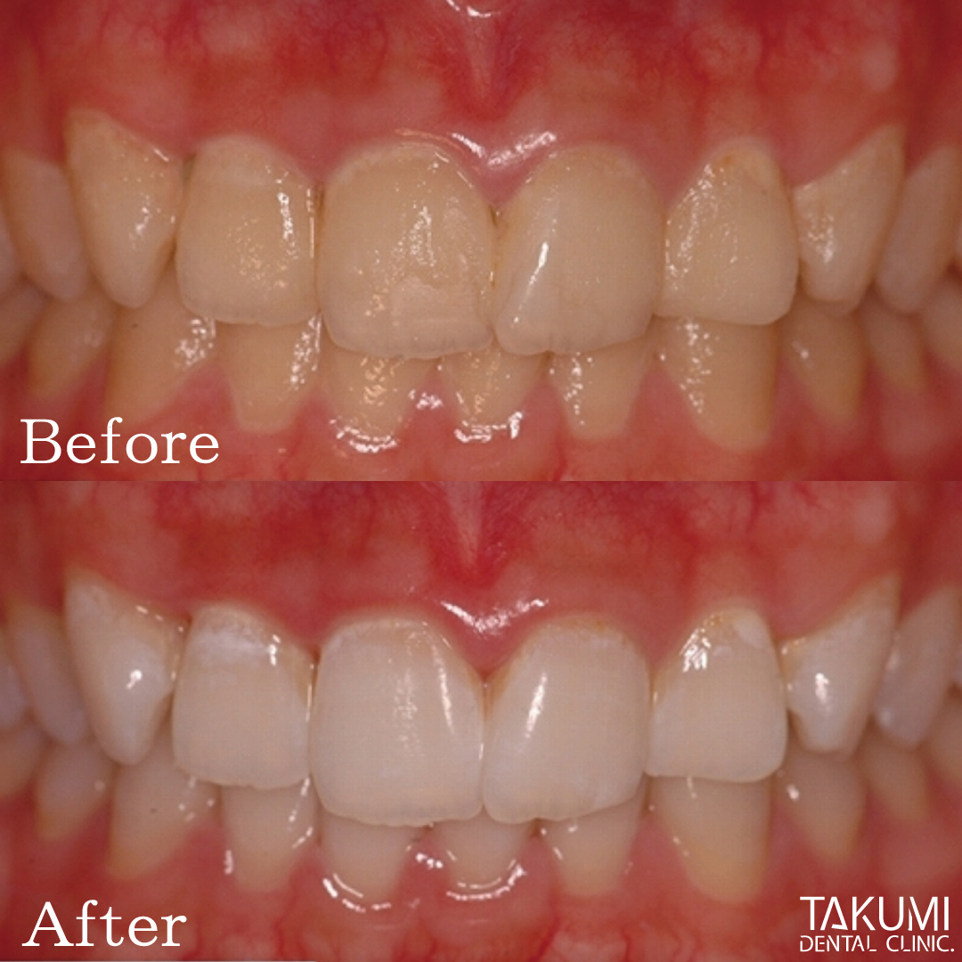 歯のホワイトニング｜匠歯科・矯正歯科｜広島市中区の歯医者